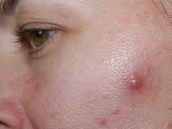 Quá trình phát triển mục bọc bắt đầu từ một đốm sưng viêm nhỏ trên da