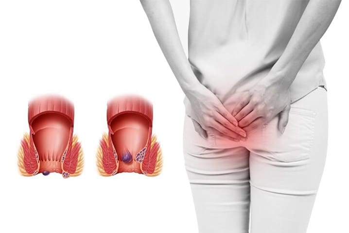 Bệnh trĩ thường ít khi gây nguy hiểm tính mạng tuy nhiên lại gây ra nhiều khó chịu, đau đớn cho bệnh nhân.