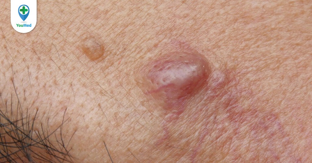 Làm gì để khắc phục tình trạng da sần sùi do u nang tuyến bã?