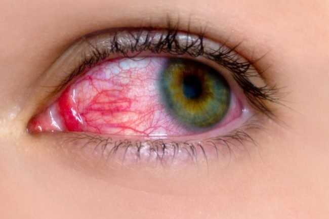 Đau mắt đỏ: Dấu hiệu và cách điều trị hiệu quả