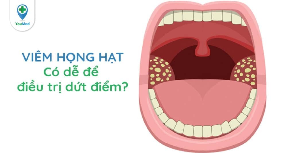 Viêm họng hạt là gì? Có dễ điều trị dứt điểm?