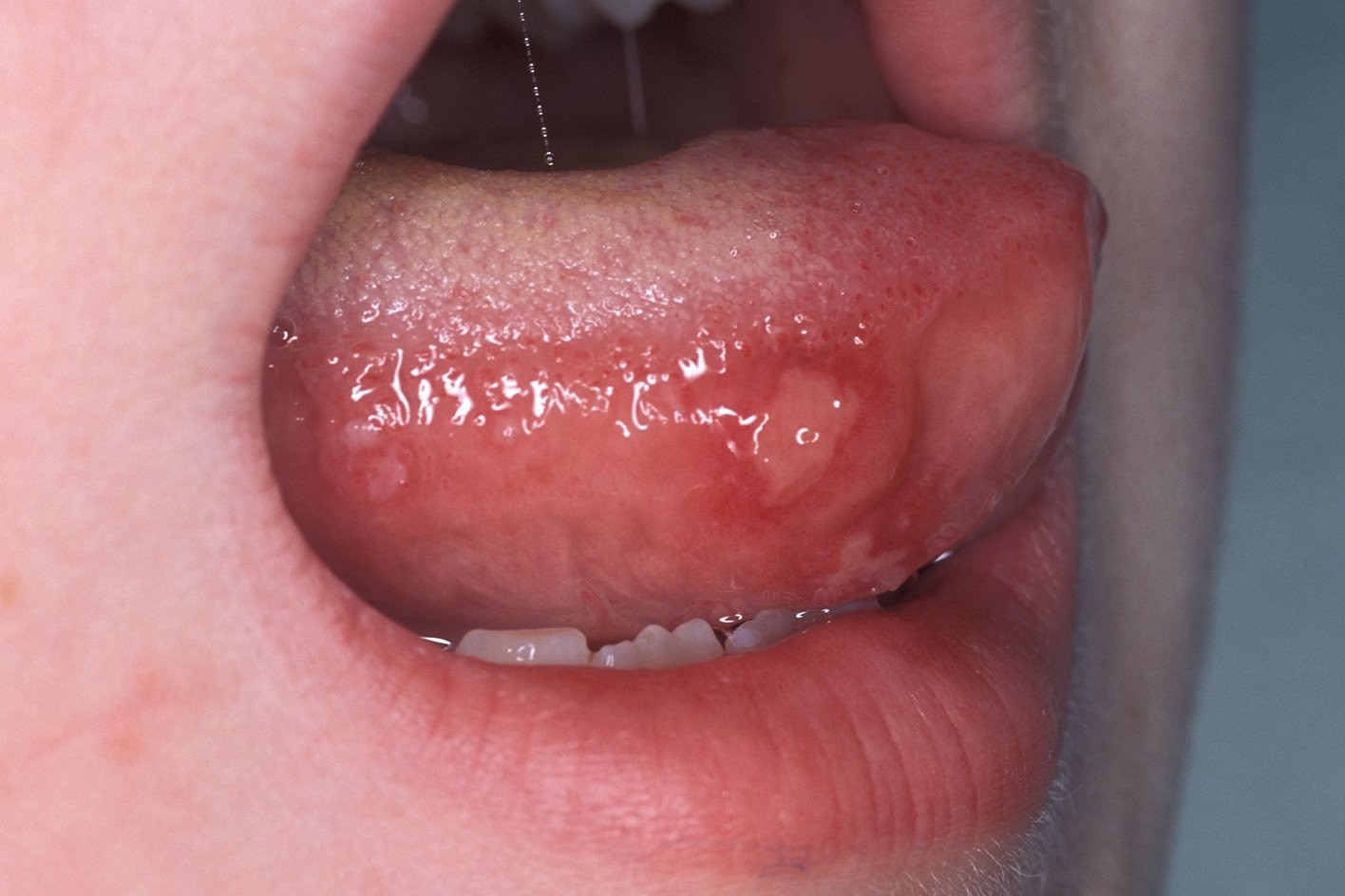 Hình ảnh vết loét ở lưỡi khi trẻ bị tay chân miệng