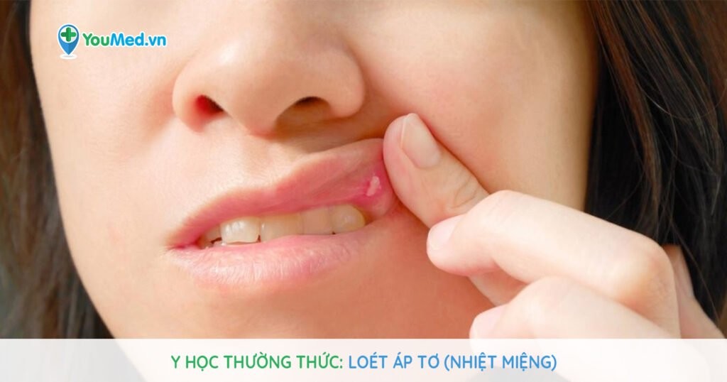Nhiệt miệng (lở miệng): nguyên nhân, cách điều trị và phòng ngừa