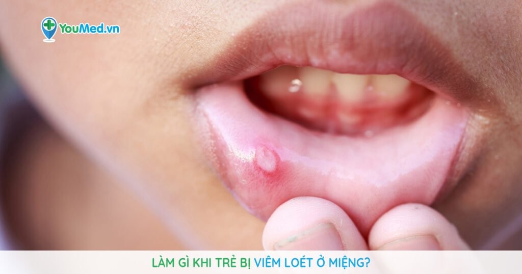 Làm gì khi trẻ bị viêm loét ở miệng?