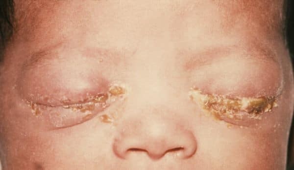 Viêm kết mạc mắt ở trẻ sơ sinh do mẹ nhiễm Chlamydia