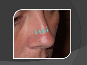 Phân biệt viêm mũi dị ứng, viêm mũi thông thường và viêm mũi xoang