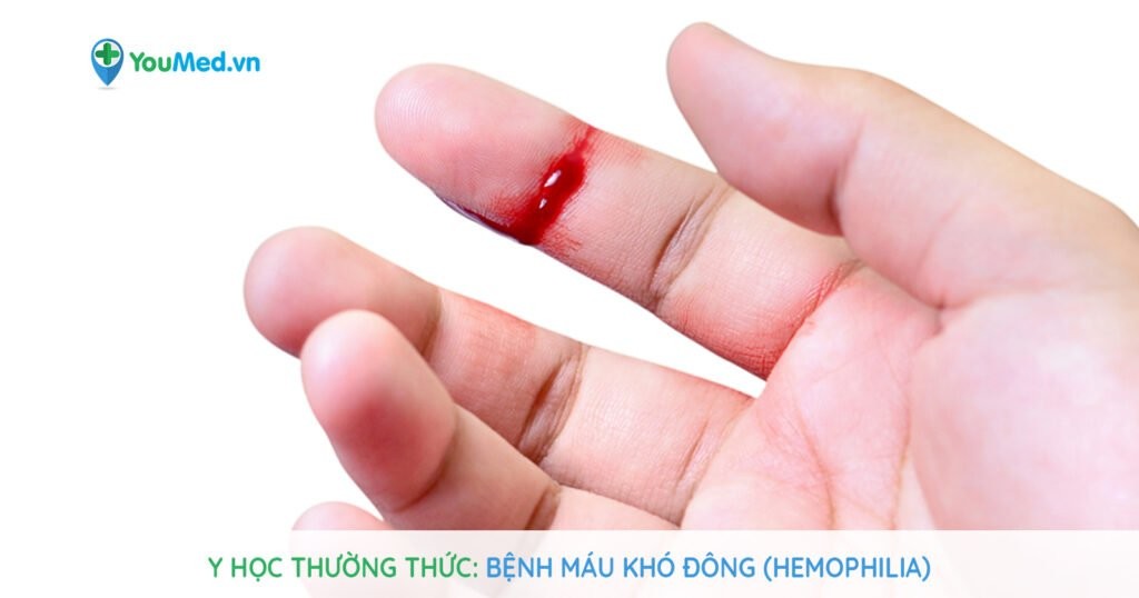 Y học thường thức: Bệnh máu khó đông (Hemophilia)
