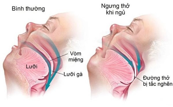 Hội chứng ngưng thở khi ngủ có 2 dạng