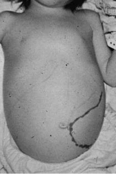 Trẻ bị tan máu bẩm sinh nặng, bụng chướng to với hình ảnh đánh dấu cấu trúc của lách to qua rốn