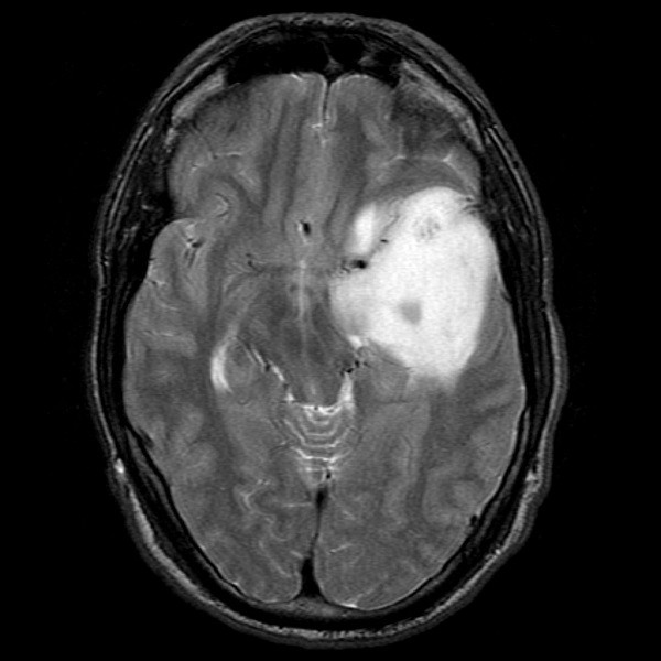 Hình ảnh sao bào trên phim cộng hưởng từ MRI
