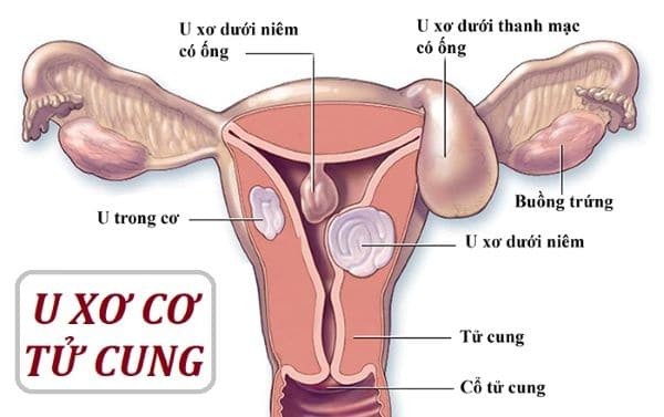Khoảng 70 - 80% phụ nữ độ tuổi trước 50 có ít nhất một u xơ - cơ ở tử cung