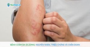 Bệnh chàm da (Eczema): Nguyên nhân, triệu chứng và chẩn đoán