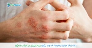 Bệnh chàm da (Eczema): Điều trị và phòng ngừa tái phát