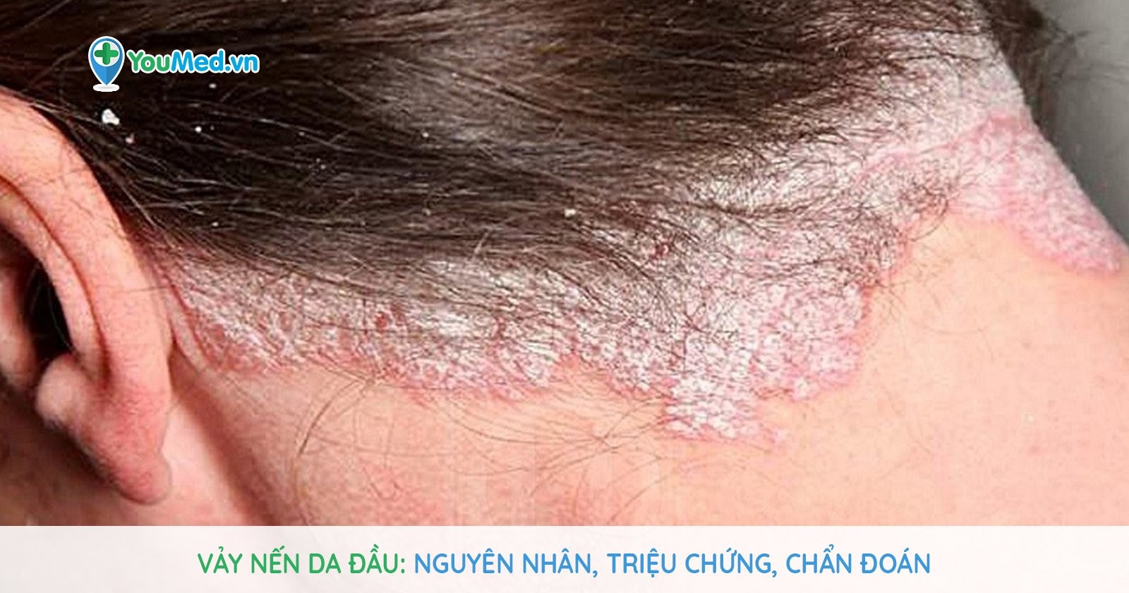 Bệnh vảy nến da đầu: Nguyên nhân, triệu chứng và cách điều trị - YouMed
