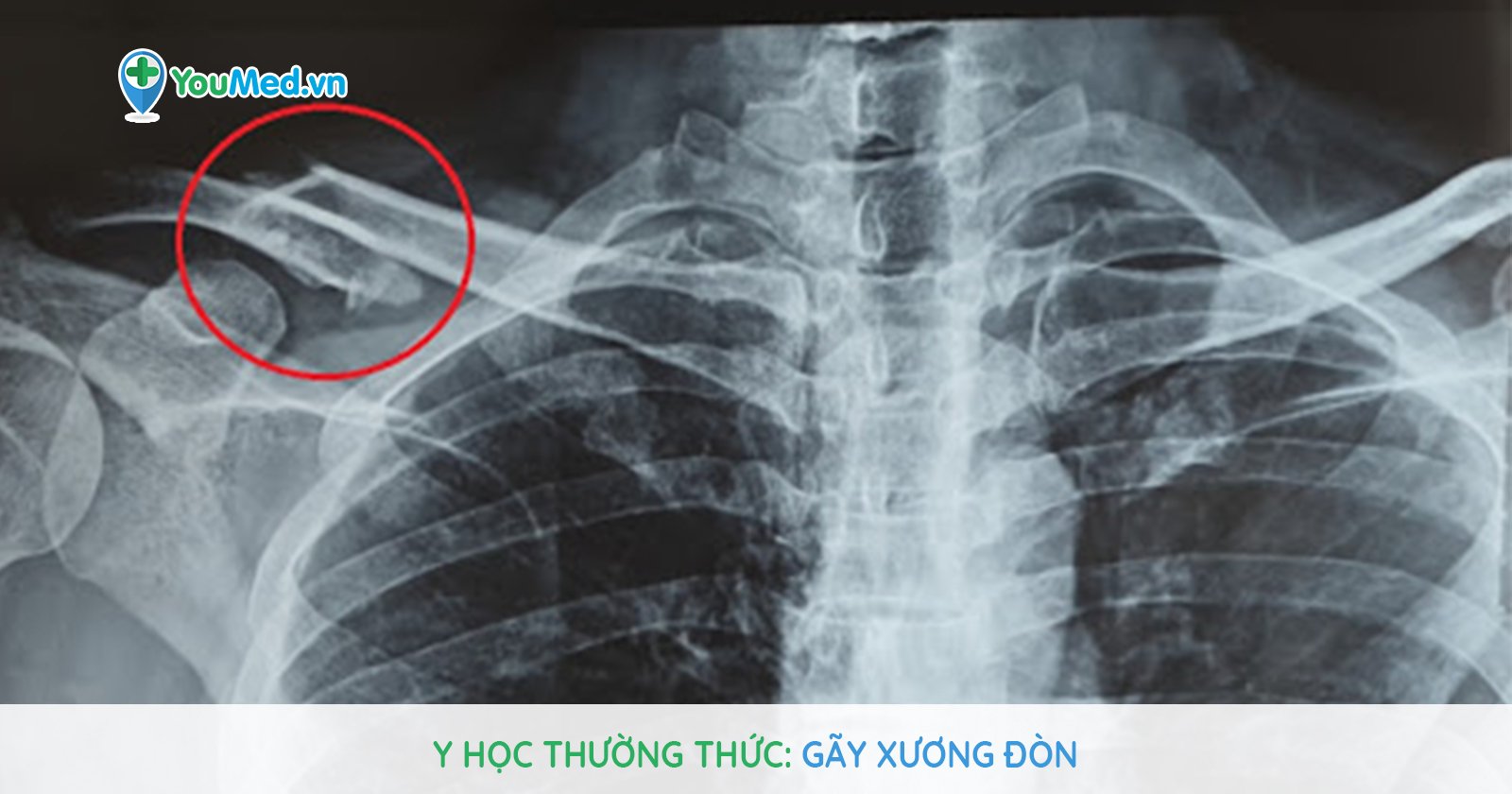Y học thường thức: Gãy xương đòn - YouMed