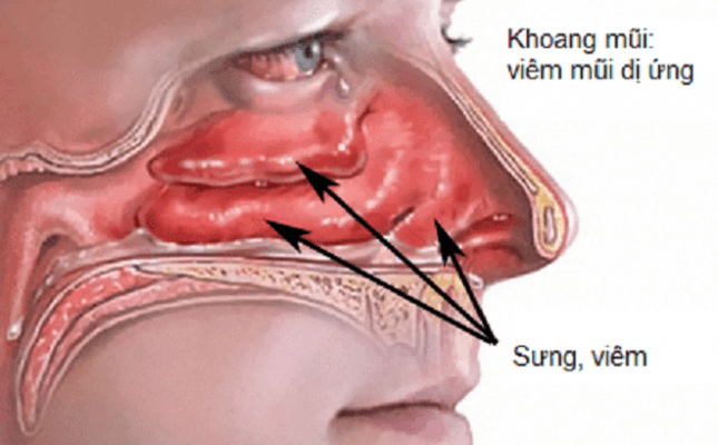 Viêm mũi dị ứng làm tăng nguy cơ xuất hiện polyp mũi