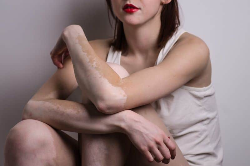 Bạch biến thường là các dát hay mảng nhạt màu trên da vùng tay, chân, mặt