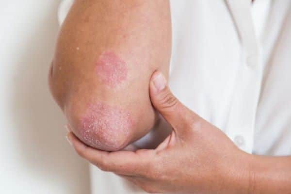 Bệnh chàm trên da thường có biểu hiện thành từng vùng da mẩn đỏ, khô và tróc vảy,...