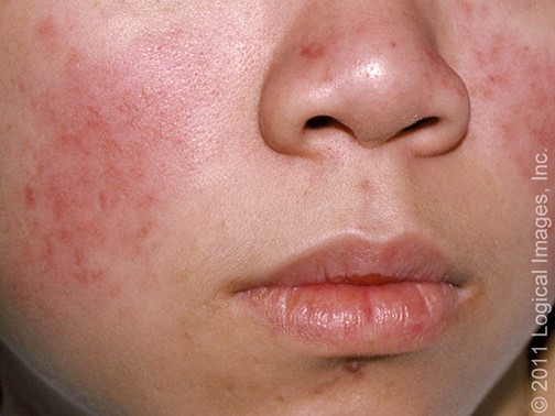 Hồng ban cánh bướm ở mắt (vị trí ở mũi và má nhưng chừa rãnh mũi má