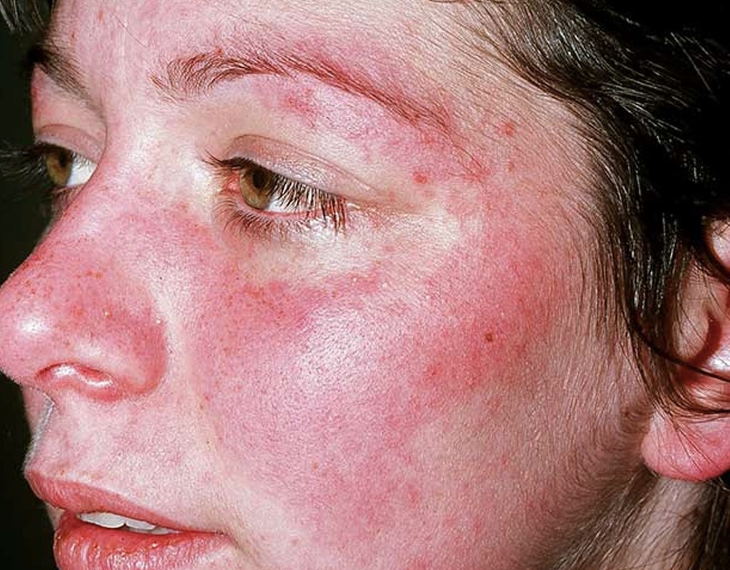 Lupus ban đỏ hệ thống là bệnh có thể ảnh hưởng đến bất kỳ cơ quan nào của cơ thể