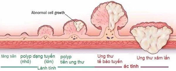 Quá trình diễn tiến thành ung thư của polyp dạng tuyến