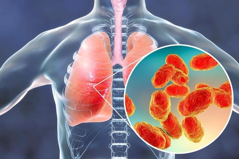 Viêm phổi là bệnh do nhiễm khuẩn, viêm nhiễm các tổ chức phổi
