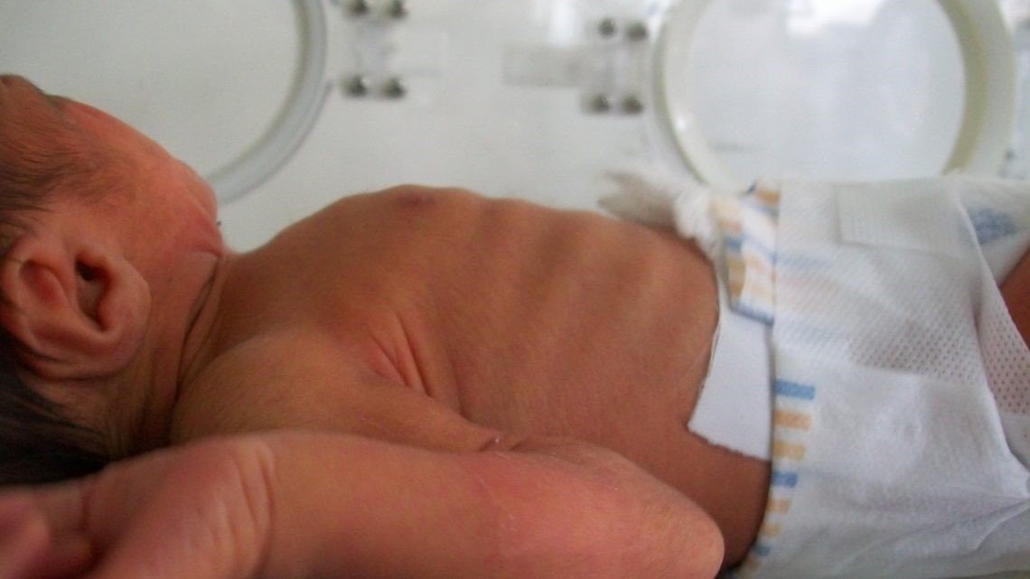 Trẻ sơ sinh với dấu hiệu thở co kéo các cơ liên sườn gợi ý tình trạng tắc nghẽn đường thở