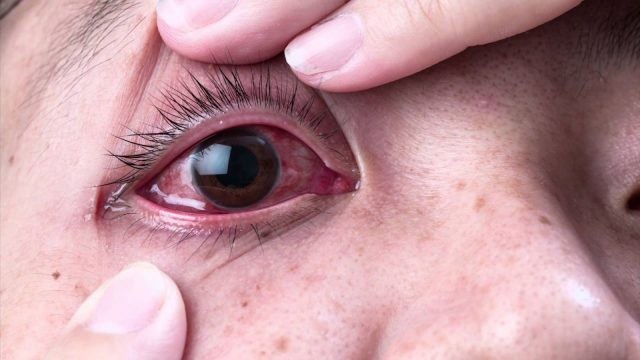 Chảy nước mắt và mắt đỏ là triệu chứng thường gặp