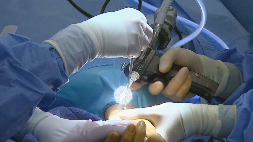 phẫu thuật nội soi hội chứng ống cổ tay