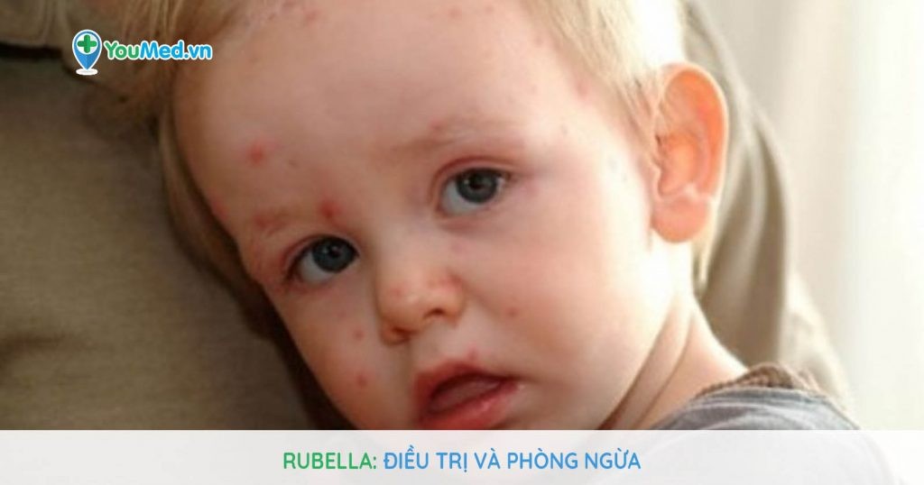 Rubella: Điều trị và phòng ngừa