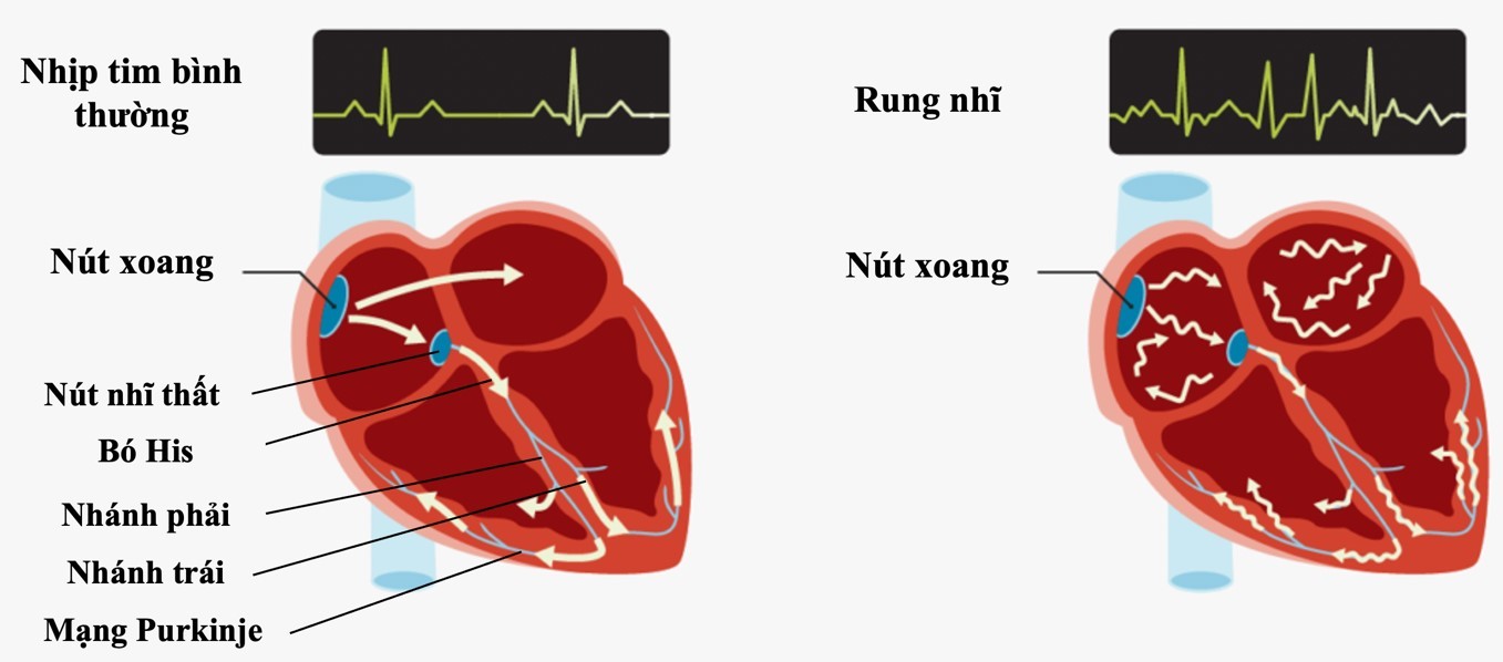 Hoạt động điện trong tim bình thường và tim bị rung nhĩ