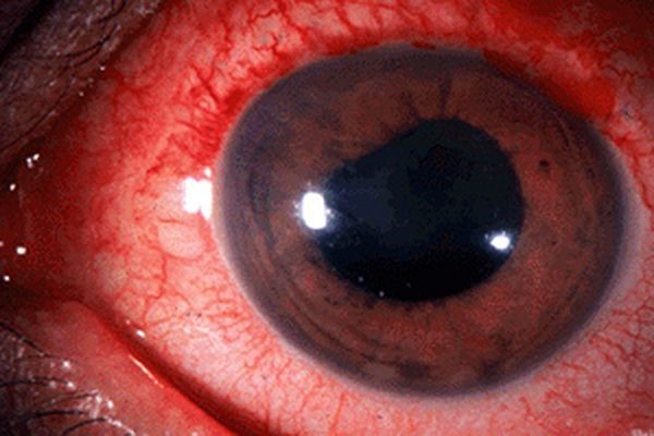 Mắt sưng đỏ là triệu chứng rất thường gặp trong viêm màng bồ đào.