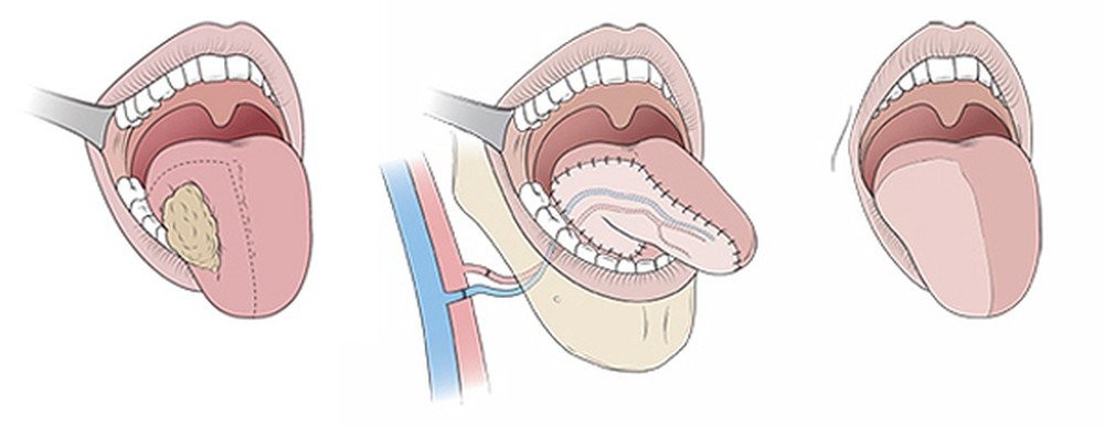 Phẫu thuật cắt một phần lưỡi và tái tạo