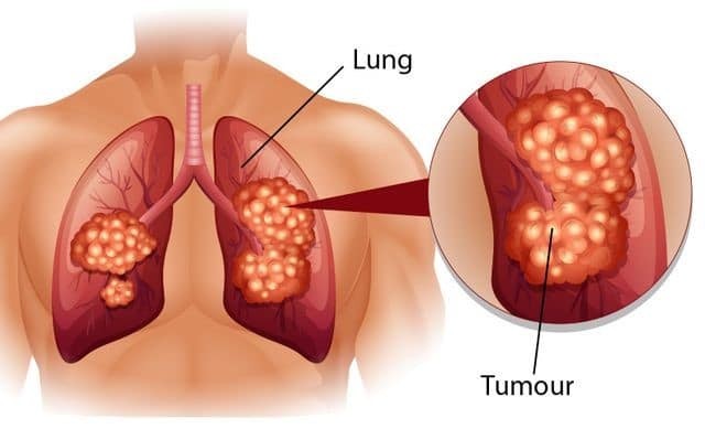 Đôi khi ung thư phổi cũng có thể đau vùng cổ và vai