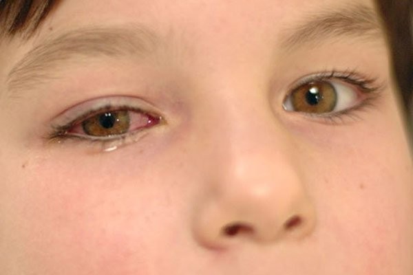 Đau mắt, đỏ mắt và chảy nước mắt là các triệu chứng nghi ngờ viêm giác mạc