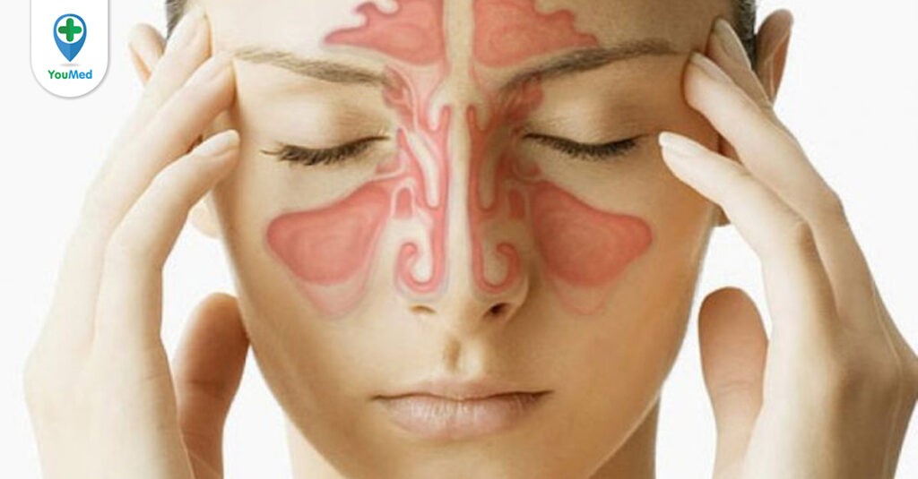 Viêm mũi xoang (Viêm xoang): Nguyên nhân, triệu chứng và cách điều trị