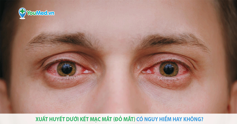 Xuất huyết dưới kết mạc mắt (đỏ mắt) có nguy hiểm hay không?