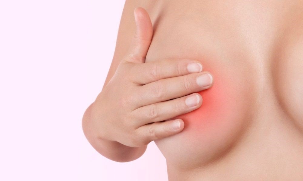 Vùng vú bị viêm hay áp-xe thường có triệu chứng: sưng, nóng, đỏ và đau