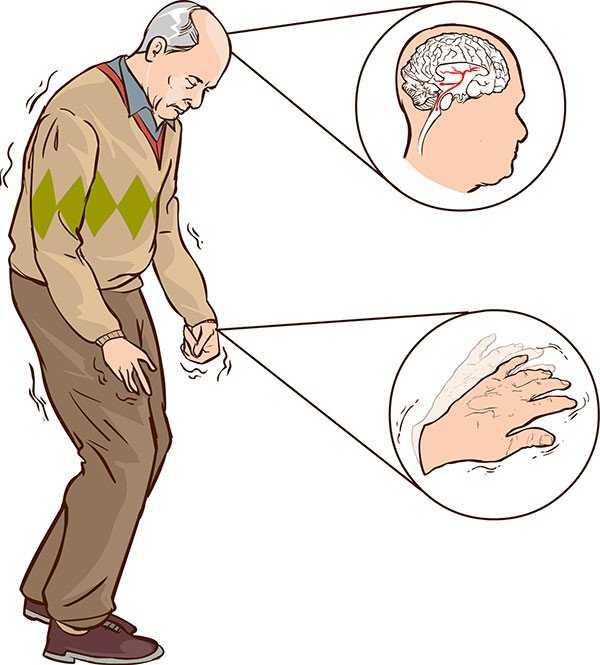 Bệnh Parkinson: Nguyên nhân, triệu chứng, điều trị, phòng ngừa - YouMed