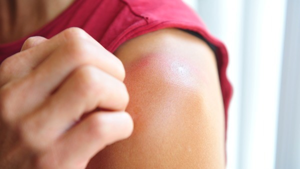 Thuốc Deferasirox (Exjade)có thể gây ra tác dụng phụ đỏ da