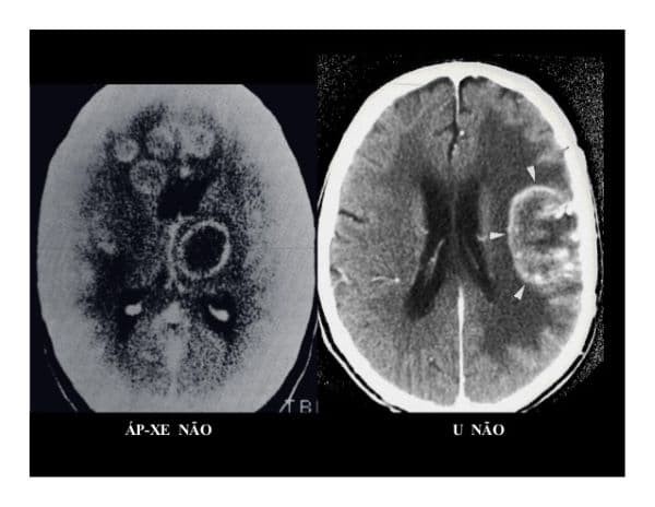 Hình ảnh áp xe não qua chụp MRI
