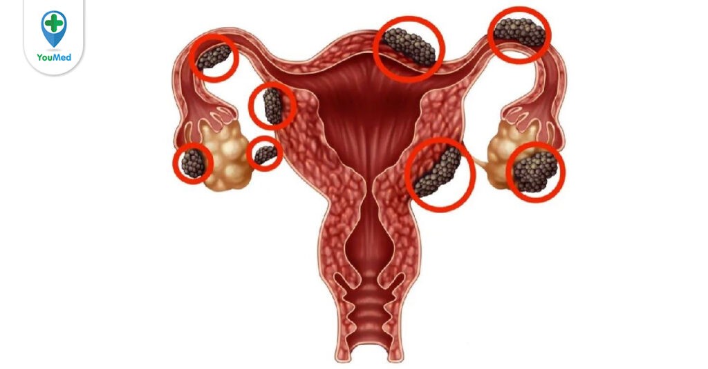 Lạc nội mạc tử cung: nguyên nhân, dấu hiệu và cách điều trị