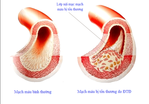 Đường tích tụ trên lớp nội mach mạch máu. làm giảm lưu lượng máu tới tưới cơ quan.