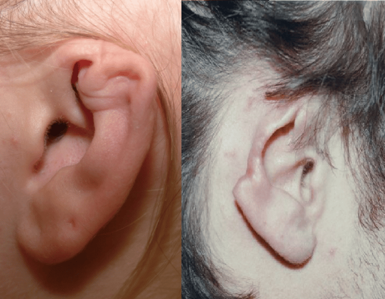 Biến chứng của viêm sụn vành tai