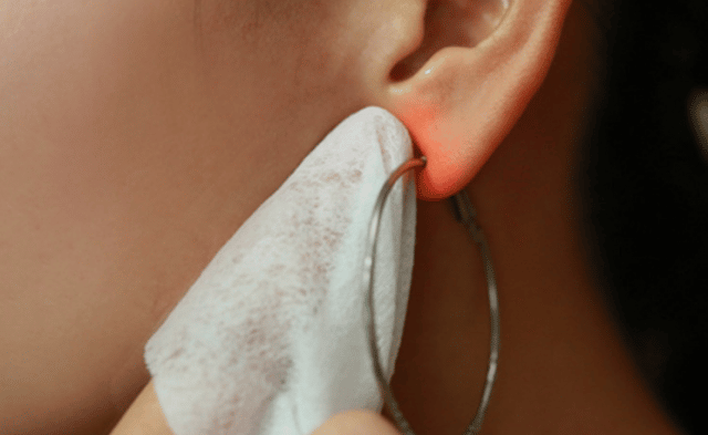 Biểu hiện của viêm sụn vành tai