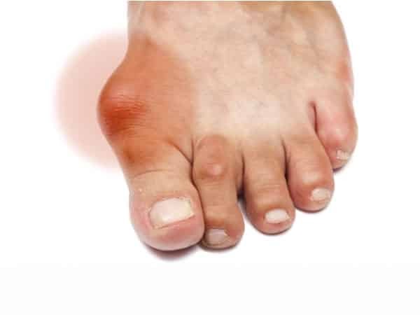 hiện tượng gout ở bàn chân