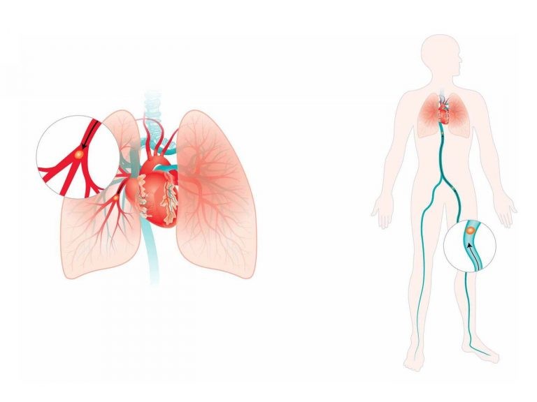 Huyết khối theo tĩnh mạch có thể gây thuyên tắc phổi