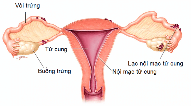 Lạc nội mạc tử cung là gì?