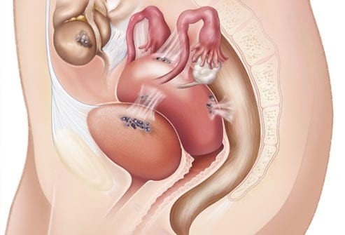 Nang lạc nội mạc tử cung có thể gây dính vùng chậu.