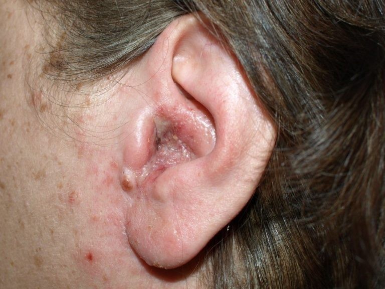 Nguyên nhân gây ra nấm tai là gì ?
